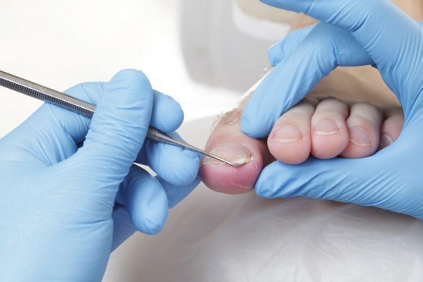 Toenail and Foot Treatment by Pure Esthetics